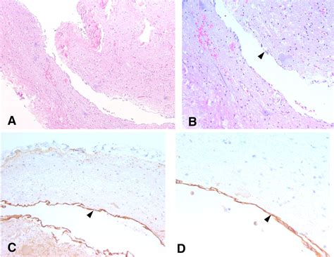 Ependymal Cyst In The Conus Medullaris Journal Of Clinical Neuroscience