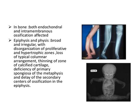 Osteogenesis Imperfecta