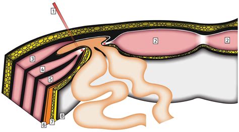 Spigelian Hernia Surgical Anatomy Drawing Depicting A Left Sided