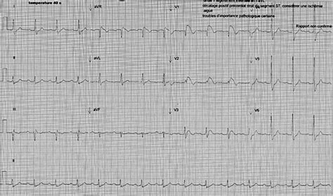 Brugada type 1 with fever at 40˚5C. | Download Scientific Diagram