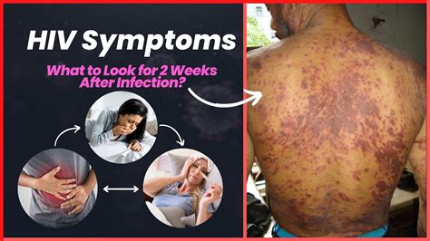 HIV Symptoms After 2 Weeks Of Infection YouTube