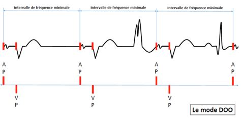 Dual Chamber Pacemaker Ecg