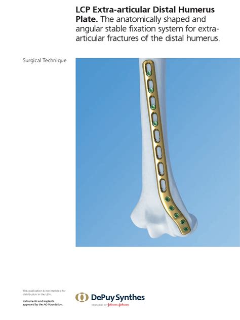 Synthes Extra Articular Distal Humerus Plate