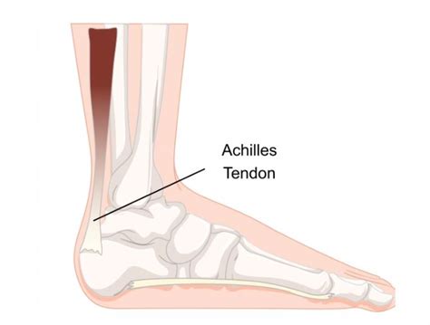 Achilles Tendinopathy The Foot Clinic Perth