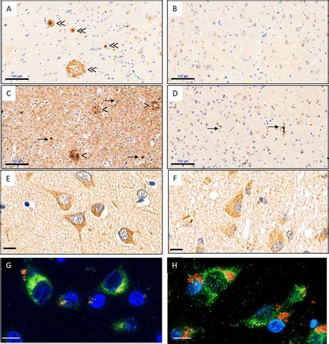 Localization Of Lgmn Is Similar In Ad And Control Temporal Cortex