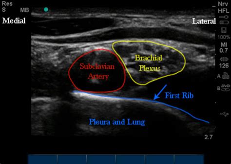 Ultrasound Anatomy Supraclav Block OpenAnesthesia