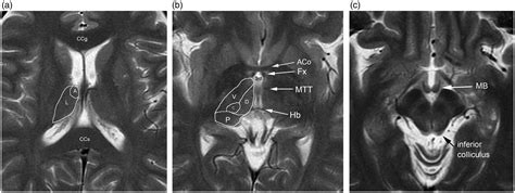 Fornix Brain Mri