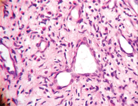 Angiolymphoid hyperplasia with arterial ectasia and arteriovenous ...