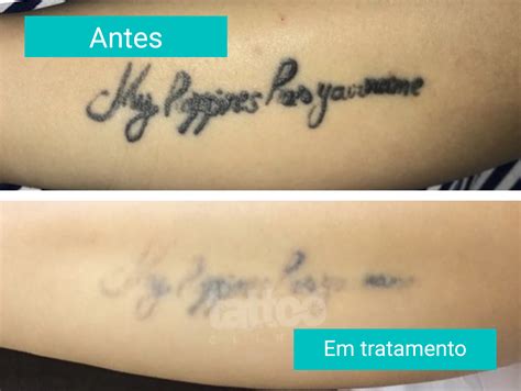 Remoção de Tatuagem a Laser Antes e Depois Tattoo Clinic