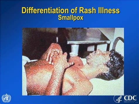 Ppt Evaluating Patients With Acute Generalized Vesicular Or Pustular Rash Illnesses Powerpoint