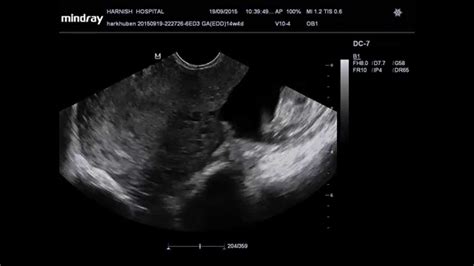 6 Weeks Ectopic Pregnancy Ultrasound