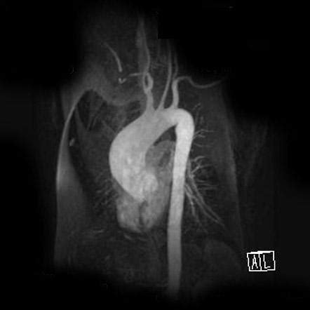 Thoracic Aortic Aneurysm Radiology Reference Article Radiopaedia Org