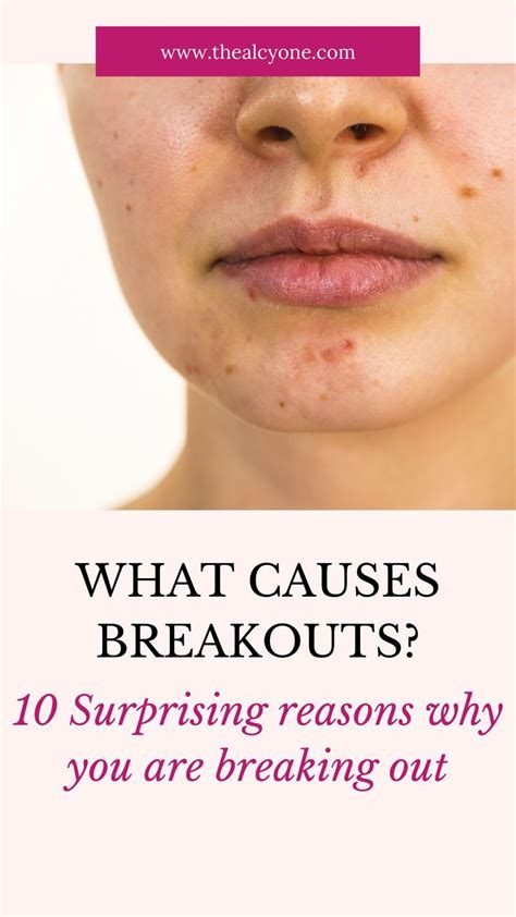 Top 10 Common Cause Of Acne And Treatments Artofit