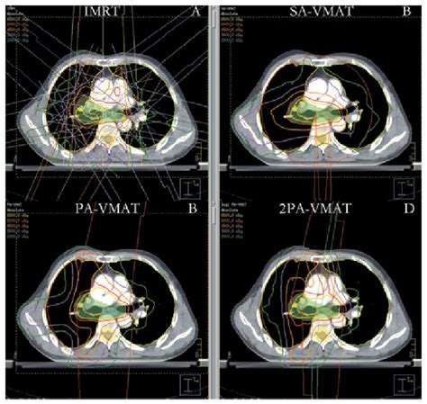 Isodose Curves Of 2pa Vmat And Imrt Plans In Central Lung Cancer In Download Scientific Diagram