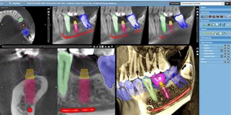 Planmeca Romexis 3d Software