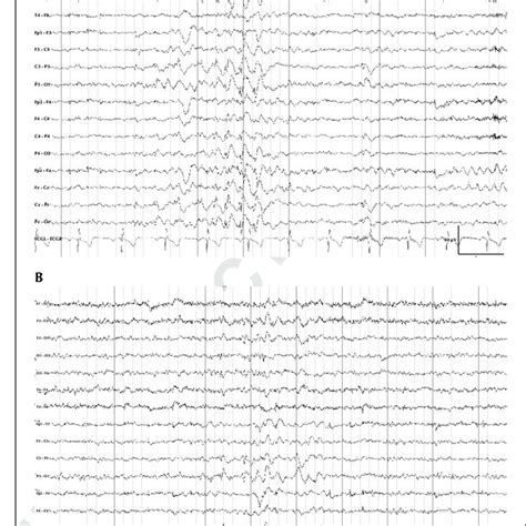 Eeg Of Patient 1 Showing A 3 Hz Generalized Spike Wave Gsw