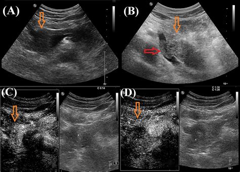 Pancreas Ultrasound