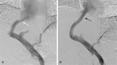 Interventional Radiology Of The Liver Radiology Key