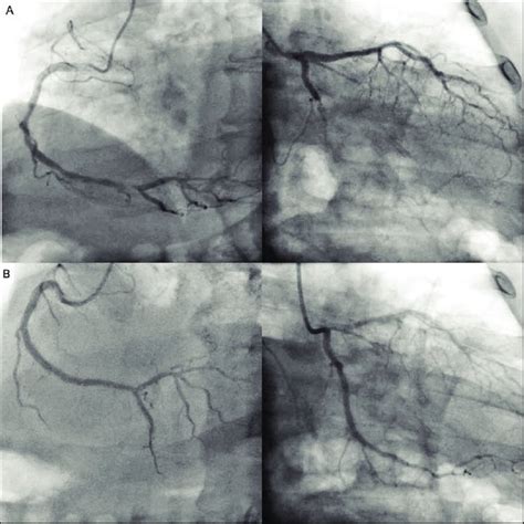 (A) Coronary Angiography Showed Total Occlusion of Circumflex Artery ...