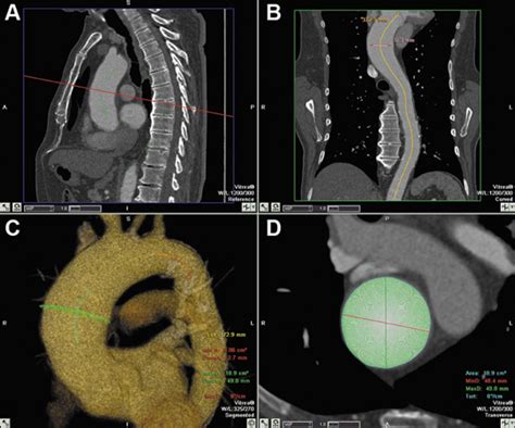 Thoracic Aorta Acute Syndromes Applied Radiology