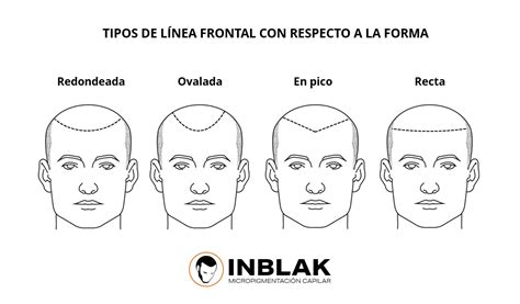 Ejemplos de línea frontal con la micropigmentación capilar en INBLAK