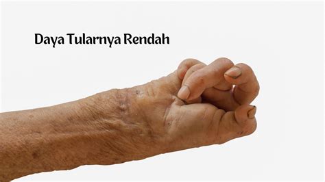 Kenali Gejala Awal Penyakit Kusta Dan Risiko Kecacatan Mamanesia