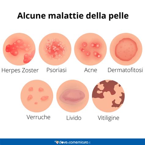 Altra Malattia Genetica Della Pelle