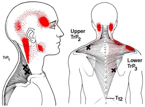 Terapia Trigger Points First Kinetic Brăila