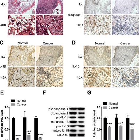 Expression Levels Of Caspase 1 Il 1β And Il 18 In Nsclc Tissues Ahe