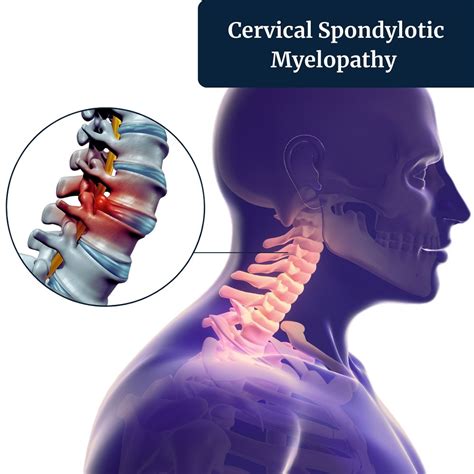 Neck Compression Treatment Irving Tx Cervical Spondylotic Myelopathy