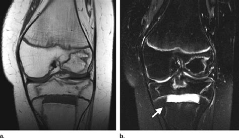 Avascular Necrosis Of The Knee In A 13 Year Old Female Adolescent After