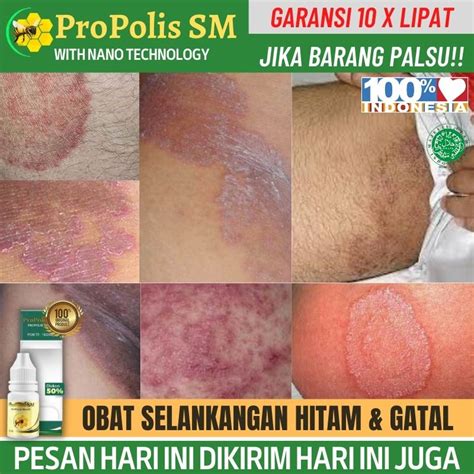 Jual Obat Gatal Selangkangan Eksim Dan Jamur Salep Gatal Selangkangan