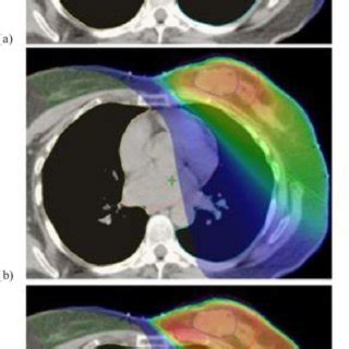 Example Of A Dose Distribution On A CT Axial Slice Down To 5 Level For