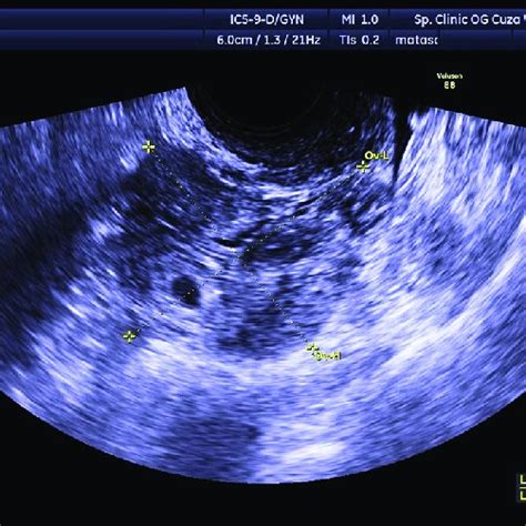 Transvaginal Ultrasound From A 28 Year Old Woman With A Left Ectopic