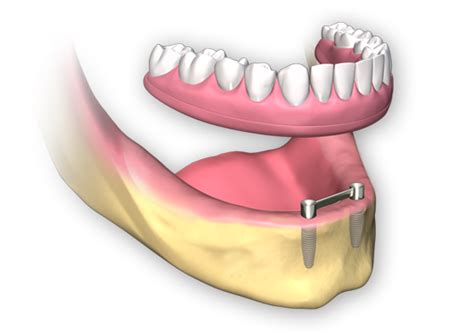 Full Arch Dental Implants