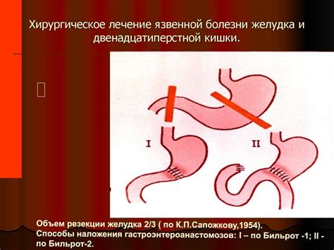 Язвенная болезнь желудка и двенадцатиперстной кишки - презентация онлайн