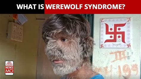 What Is The Werewolf Syndrome Madhya Pradesh Teen Diagnosed With