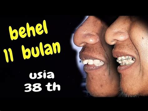 Bulan Progres Perawatan Behel Gigi Tonggos Umur Tahun Dokter