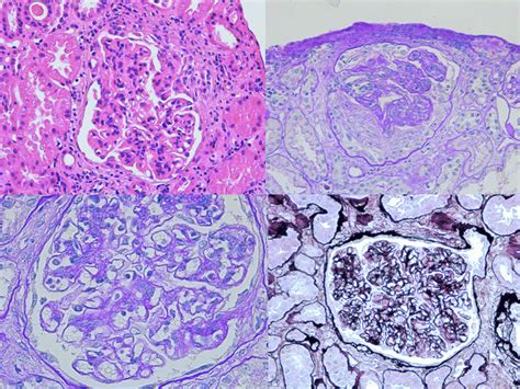 Microscopia óptica se observa proliferación mesangial e Download