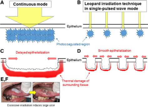 Schema Of Thermal Effects Of Laser Irradiation In Continuous