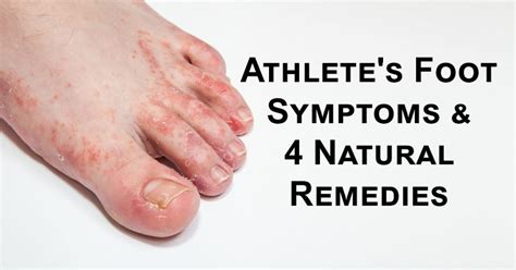 Athlete's Foot Symptoms & 4 Natural Remedies - DavidWolfe.com