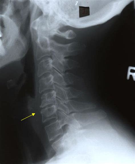 Degenerative Disc Disease With Disc Space Narrowing And Anterior