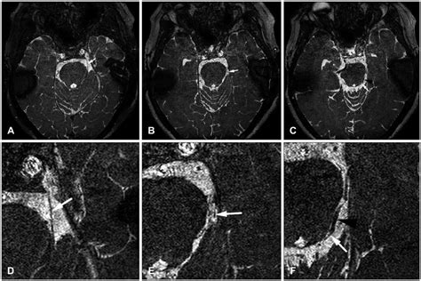 Trochlear Nerve Mri