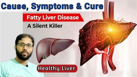 Fatty Liver Causes Symptoms And Treatment Fatty Liver Diet Liver Detox Video Youtube