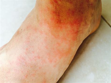 Skin Rashes On Feet