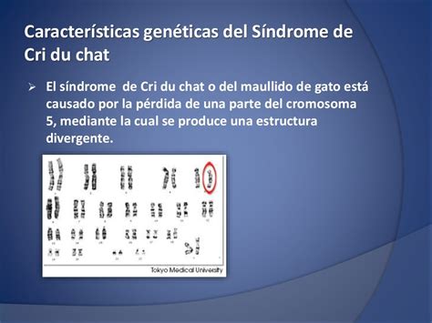 Síndrome De Cri Du Chat Investigación Escolar