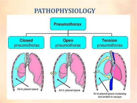 Clin Med Chest Trauma And Pneumothorax Ii Flashcards Quizlet