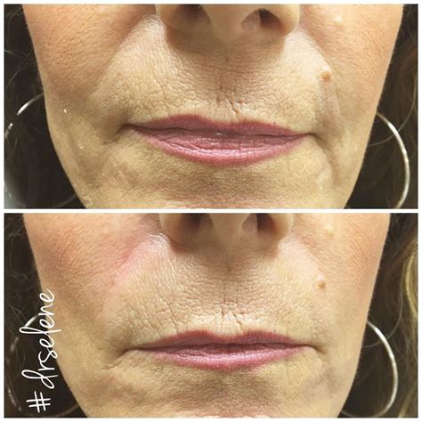 Dermal Fillers Nasolabial Folds