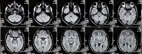 CT scan Brain/Head with Contrast OR Contrast-enhanced CT scan study of ...