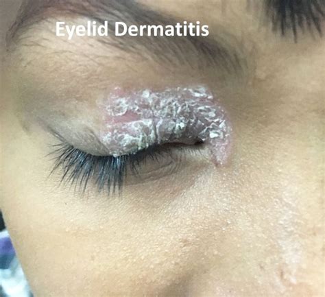 Dermatitis and eczema of the eyelids